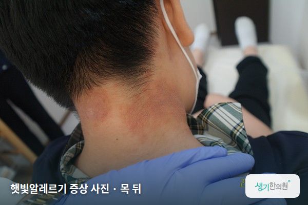 목 뒤에 생긴 햇빛알레르기 증상 사진 — 햇빛알레르기 증상 사진 · 목 뒤