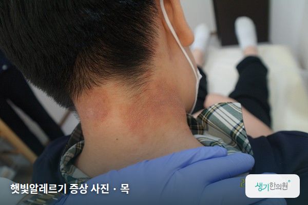 목에 생긴 햇빛알레르기 증상 사진