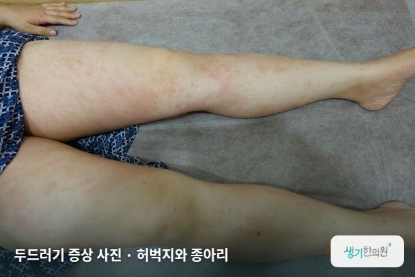 허벅지와 종아리에 생긴 두드러기 증상 사진 — 두드러기 증상 사진 · 허벅지와 종아리