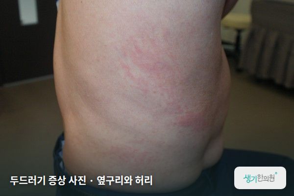 옆구리와 허리에 생긴 두드러기 증상 사진 — 두드러기 증상 사진 · 옆구리와 허리