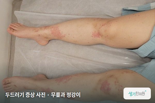 무릎과 정강이에 생긴 두드러기 증상 사진 — 두드러기 증상 사진 · 무릎과 정강이