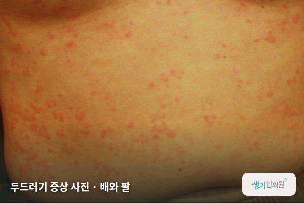 배와 팔에 생긴 두드러기 증상 사진 — 두드러기 증상 사진 · 배와 팔