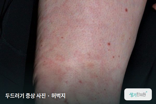 허벅지에 생긴 두드러기 증상 사진 — 두드러기 증상 사진 · 허벅지