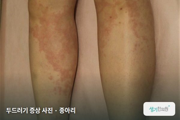 종아리에 생긴 두드러기 증상 사진 — 두드러기 증상 사진 · 종아리