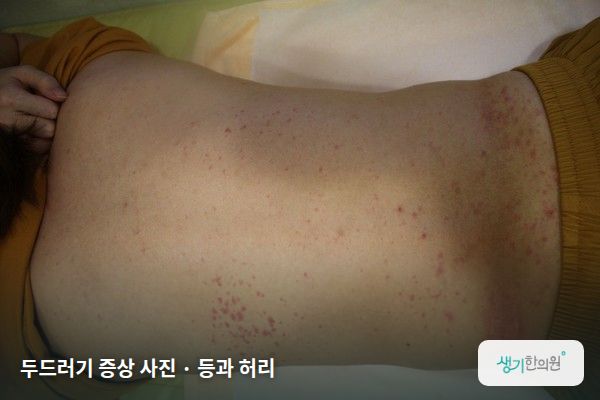 등과 허리에 생긴 두드러기 증상 사진 — 두드러기 증상 사진 · 등과 허리