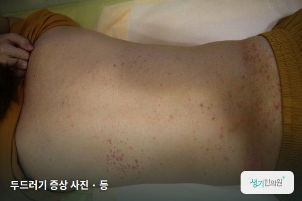 등에 생긴 두드러기 증상 사진 — 두드러기 증상 사진 · 등