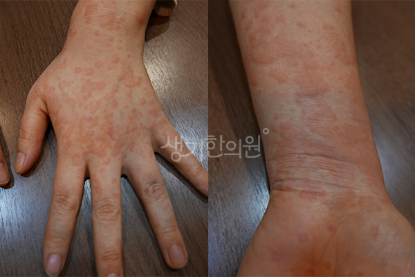 손등과 손목의 두드러기 증상 사진