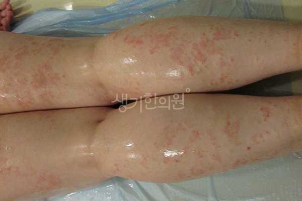 다리 뒷면의 두드러기 증상 사진