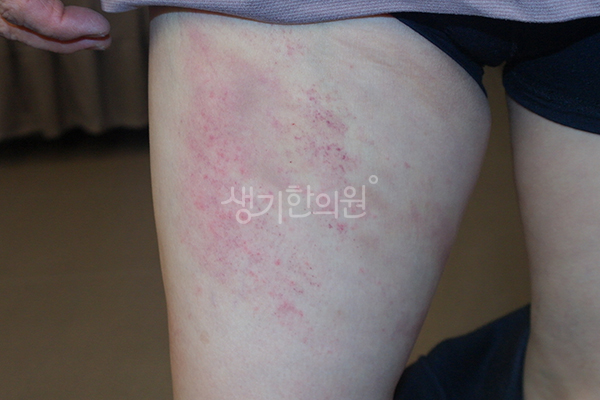 허벅지의 두드러기 증상 사진