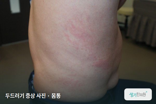 몸통에 생긴 두드러기 증상 사진 — 두드러기 증상 사진 · 몸통