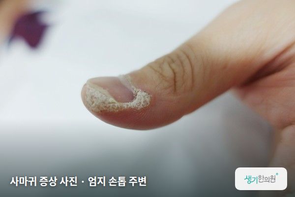 엄지 손톱 주변에 생긴 사마귀 증상 사진 — 사마귀 증상 사진 · 엄지 손톱 주변