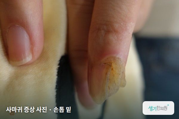 손톱 밑에 생긴 사마귀 증상 사진 — 사마귀 증상 사진 · 손톱 밑