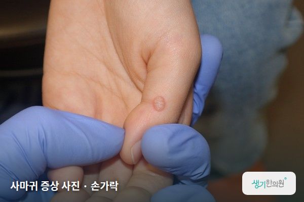 손가락에 생긴 사마귀 증상 사진 — 사마귀 증상 사진 · 손가락