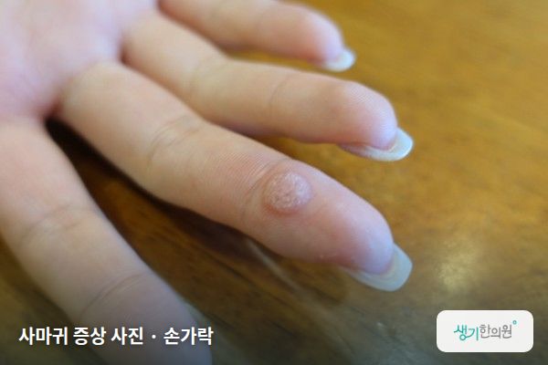 손가락에 생긴 사마귀 증상 사진 — 사마귀 증상 사진 · 손가락