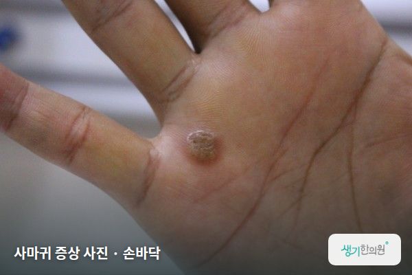 손바닥에 생긴 사마귀 증상 사진 — 사마귀 증상 사진 · 손바닥