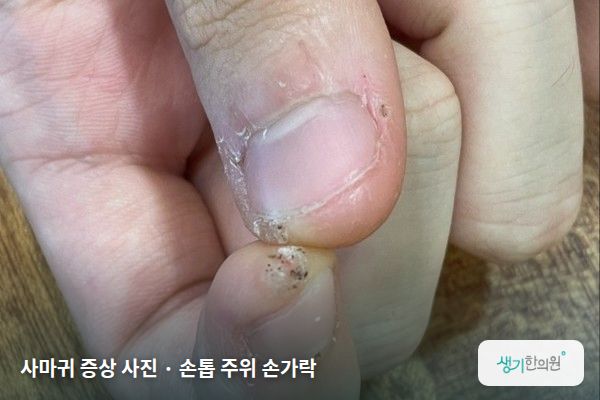 손톱 주위 손가락에 생긴 사마귀 증상 사진 — 사마귀 증상 사진 · 손톱 주위 손가락