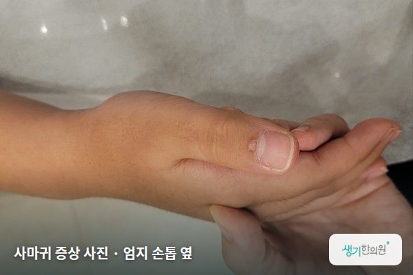 엄지 손톱 옆에 생긴 사마귀 증상 사진 — 사마귀 증상 사진 · 엄지 손톱 옆