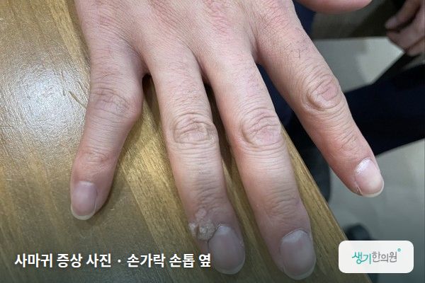 손가락 손톱 옆에 생긴 사마귀 증상 사진 — 사마귀 증상 사진 · 손가락 손톱 옆