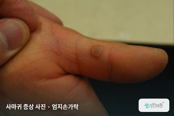 엄지손가락에 생긴 사마귀 증상 사진 — 사마귀 증상 사진 · 엄지손가락