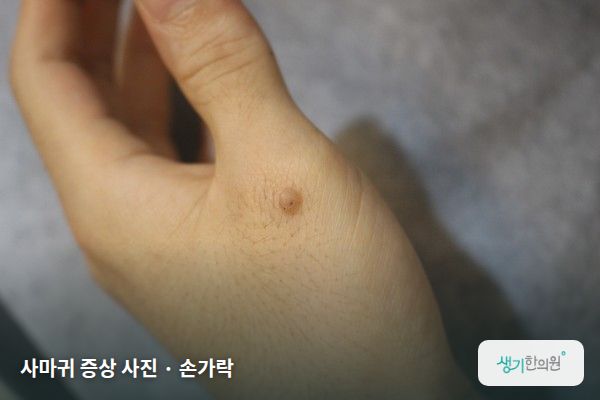 손가락에 생긴 사마귀 증상 사진 — 사마귀 증상 사진 · 손가락
