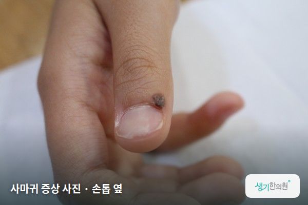 손톱 옆에 생긴 사마귀 증상 사진 — 사마귀 증상 사진 · 손톱 옆