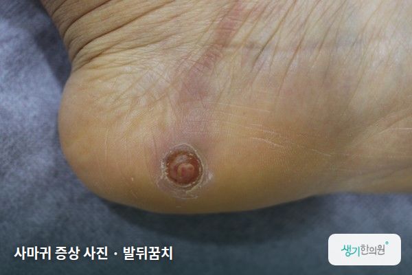 발뒤꿈치에 생긴 사마귀 증상 사진 — 사마귀 증상 사진 · 발뒤꿈치