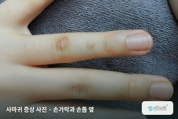 손가락과 손톱 옆에 생긴 사마귀 증상 사진 — 사마귀 증상 사진 · 손가락과 손톱 옆
