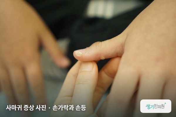 손가락과 손등에 생긴 사마귀 증상 사진 — 사마귀 증상 사진 · 손가락과 손등