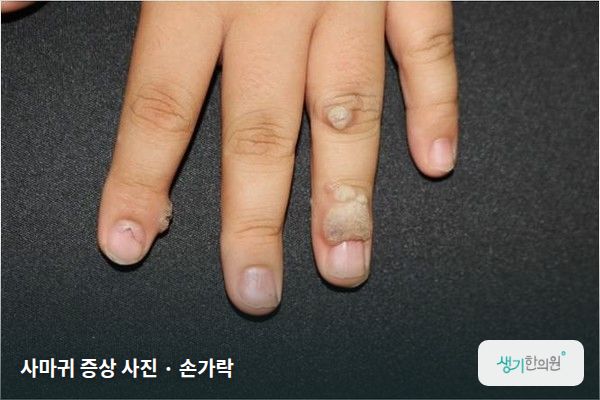 손가락에 생긴 사마귀 증상 사진 — 사마귀 증상 사진 · 손가락