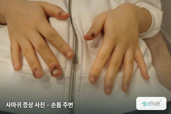 손톱 주변에 생긴 사마귀 증상 사진 — 사마귀 증상 사진 · 손톱 주변