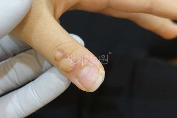 손톱 옆 사마귀 증상 사진