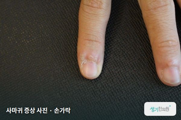 손가락에 생긴 사마귀 증상 사진 — 사마귀 증상 사진 · 손가락
