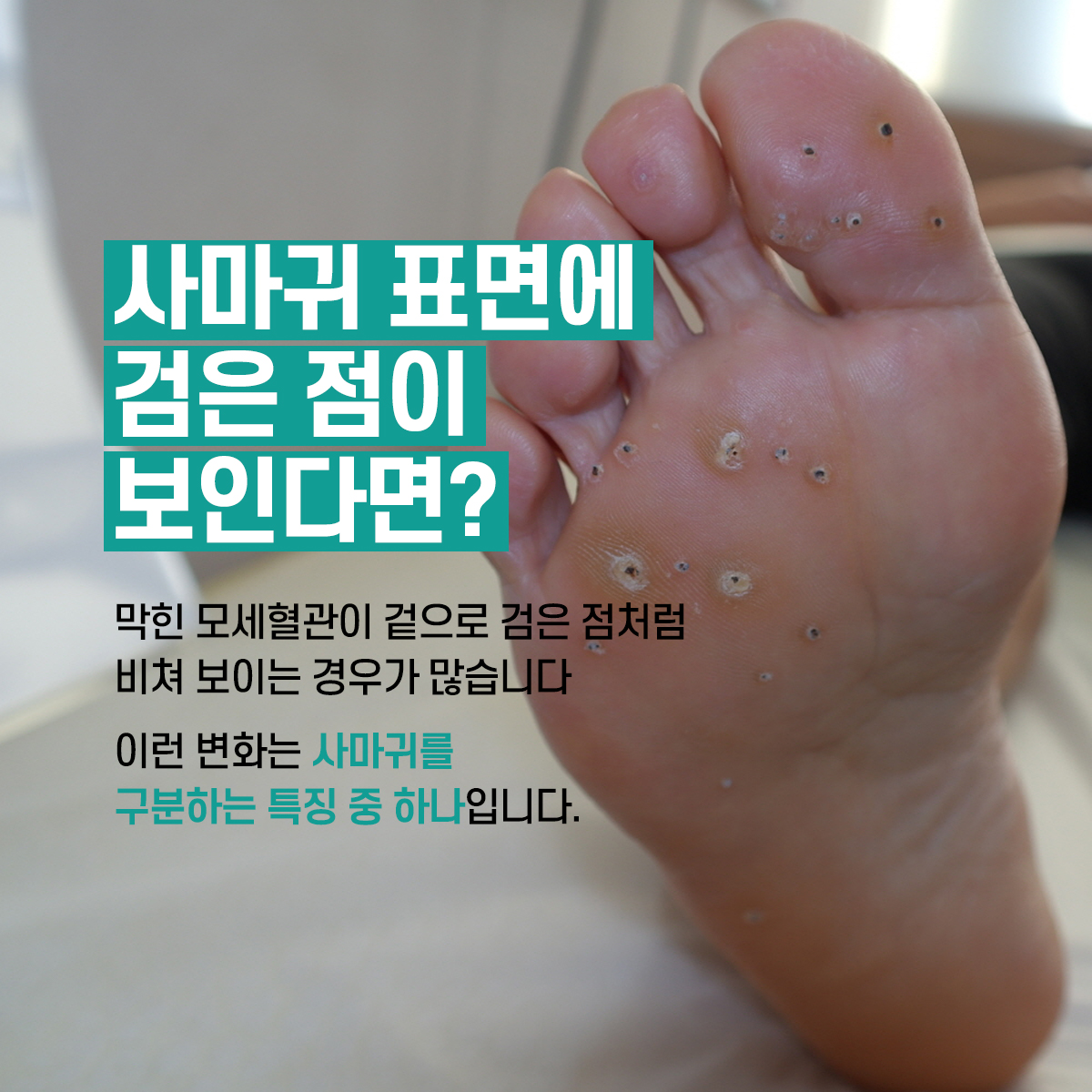 발바닥 사마귀 사진과 문구 「막힌 모세혈관이 겉으로 검은 점처럼 비쳐 보이는 경우가 많습니다.」